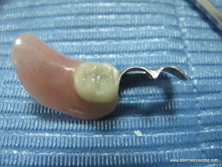Precision Attachment Removable Partial Denture for a missing tooth - denturesguide.com