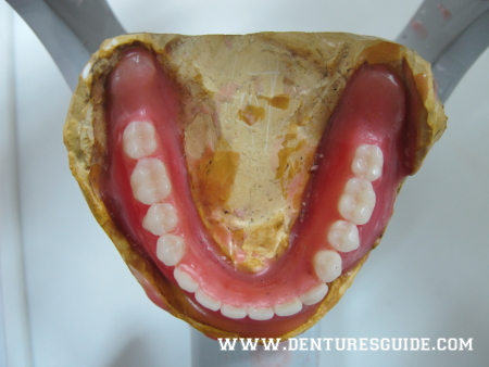 Lower trial denture. - denturesguide.com